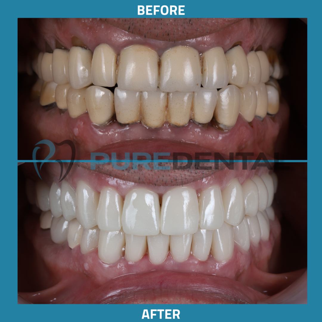 Fogászati korona Budapesten