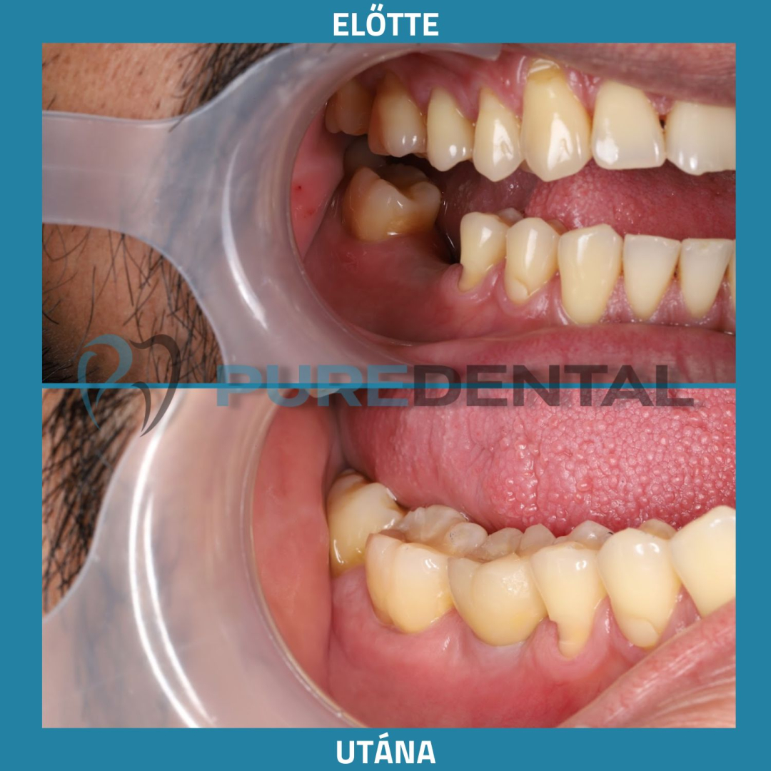Fogkorona és foghíd eredmény Budapesten Fogkorona és foghíd eredmény Budapest